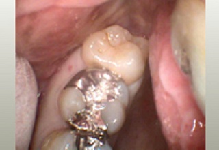 上のまっすぐに生えた親知らずの抜歯の例です。手前の銀歯との境がうっすら黒くなっているのがわかります。