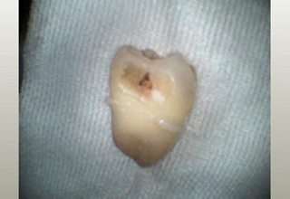 抜歯した親知らずです。歯の側面に黒い虫歯が見られます。根はおもったより大きくて長いのです。