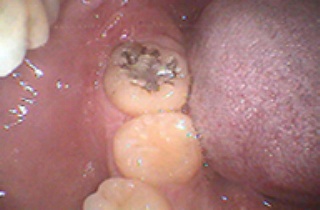 下のまっすぐに生えた親知らずの抜歯の例です。銀歯の辺縁から虫歯ができています。また奥の歯肉が炎症をおこして赤く腫れています。