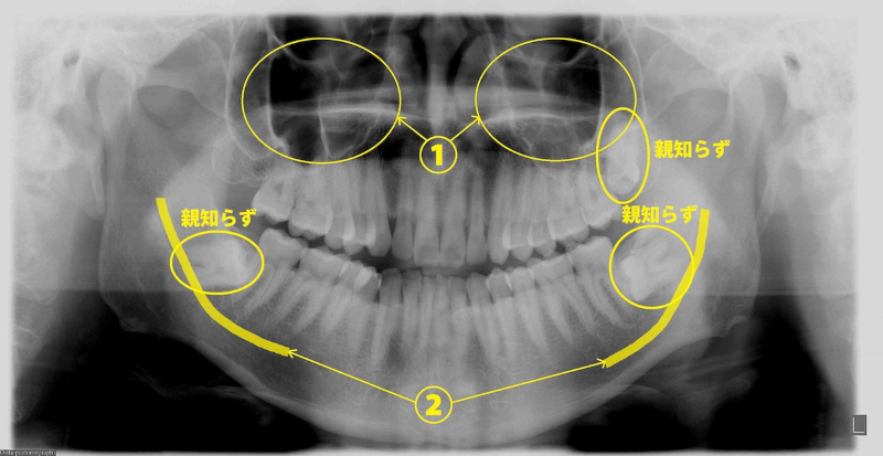 親知らず上顎洞と下顎管