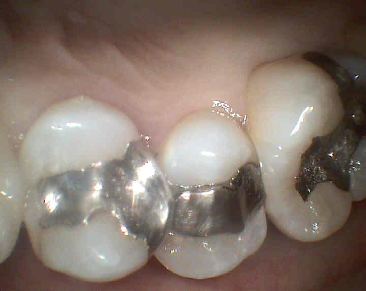 適合性の悪い銀歯