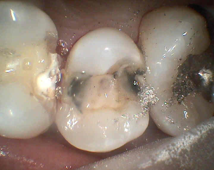 銀歯を外した状態虫歯ができている